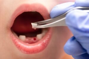 Close-up da boca de uma criança após a extração de um dente de leite, com uma pinça segurando o dente removido e uma pequena área de sangramento visível na gengiva.