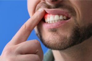 Homem levantando o lábio superior com o dedo para mostrar gengiva avermelhada e inflamada, indicando possível dor ou inflamação gengival.