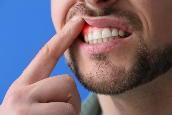 Homem levantando o lábio superior com o dedo para mostrar gengiva avermelhada e inflamada, indicando possível dor ou inflamação gengival.