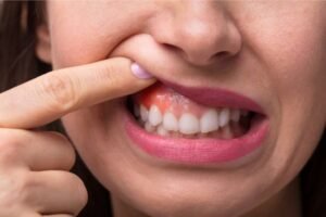 Close-up de uma mulher levantando o lábio superior com o dedo para mostrar uma gengiva avermelhada, inchada e com sinais de inflamação.