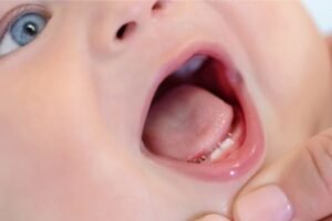 Close-up da boca aberta de um bebê, destacando gengivas inchadas e os primeiros dentinhos inferiores em processo de erupção.
