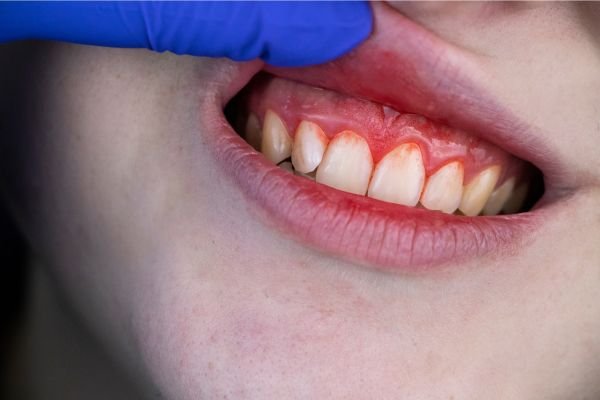 gengivas inflamadas e avermelhadas, enquanto um profissional de saúde com luva azul levanta os lábios superiores para inspeção.