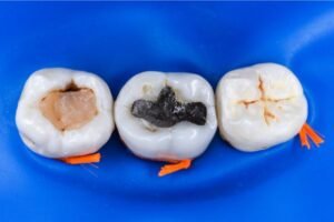 Imagem de três dentes isolados por uma barreira de borracha azul, mostrando diferentes tipos de obturação no dente: resina composta, amálgama e restauração selada.