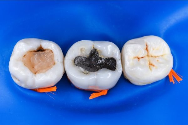Imagem de três dentes isolados por uma barreira de borracha azul, mostrando diferentes tipos de obturação no dente: resina composta, amálgama e restauração selada.