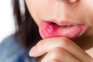 Close-up do lábio inferior de uma pessoa sendo puxado com o dedo para mostrar uma lesão avermelhada e inflamada, semelhante a uma afta ou úlcera.