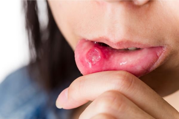 Close-up do lábio inferior de uma pessoa sendo puxado com o dedo para mostrar uma lesão avermelhada e inflamada, semelhante a uma afta ou úlcera.