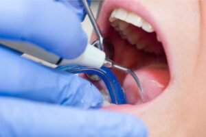 Close-up de um procedimento odontológico para remoção de tártaro, com instrumentos como ultrassom e espelho sendo usados ​​por um dentista com luvas azuis.