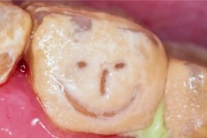 Close-up de um dente com acúmulo severo de tártaro, apresentando uma aparência amarelada e duradoura, com uma marcação em formato de rosto sorridente.