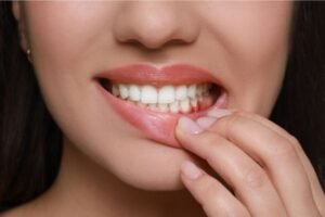Mulher levantando o lábio inferior com os dedos para revelar gengivas avermelhadas e inflamadas, sugerindo sinais de infecção ou inflamação bucal.